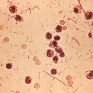 Shigella_stool Shigella